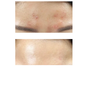 Уход для проблемной кожи